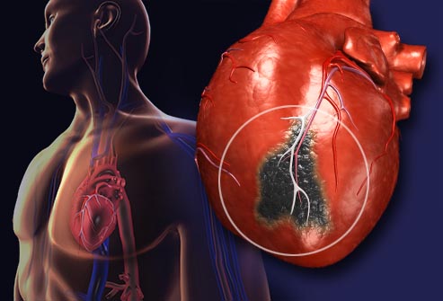 airpollutioneffectyourheart